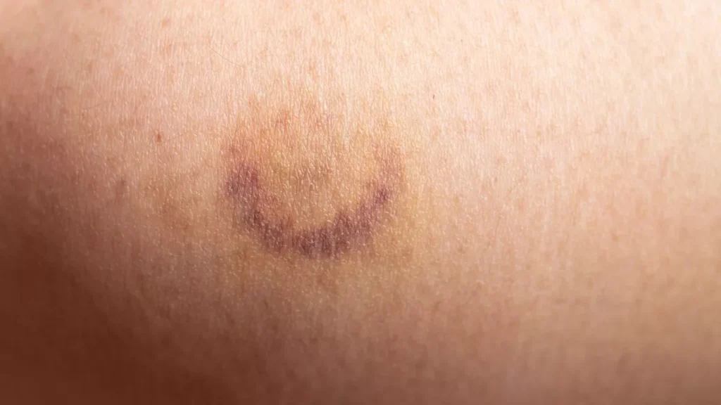 Leukaemia: Early Warning Signs You Should Never Ignore